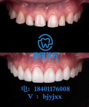 牙齒美白哪里可以學到最好技術 北京牙齒美白美牙培訓學校