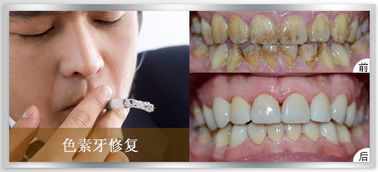 牙齒美白方法大全