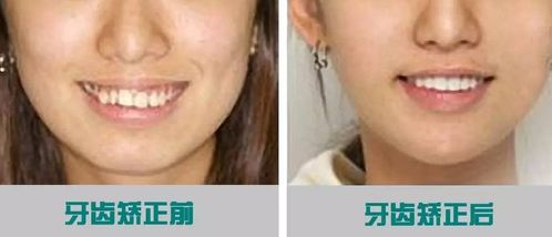 昌平牙齒矯正的方法有哪些呢
