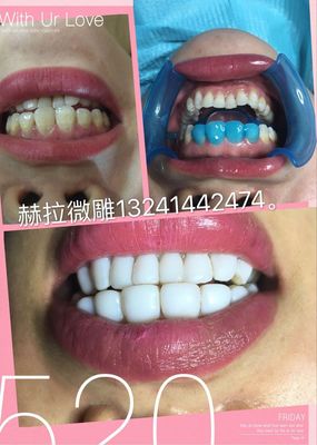濟南牙齒美容,納米炫齒浮雕培訓
