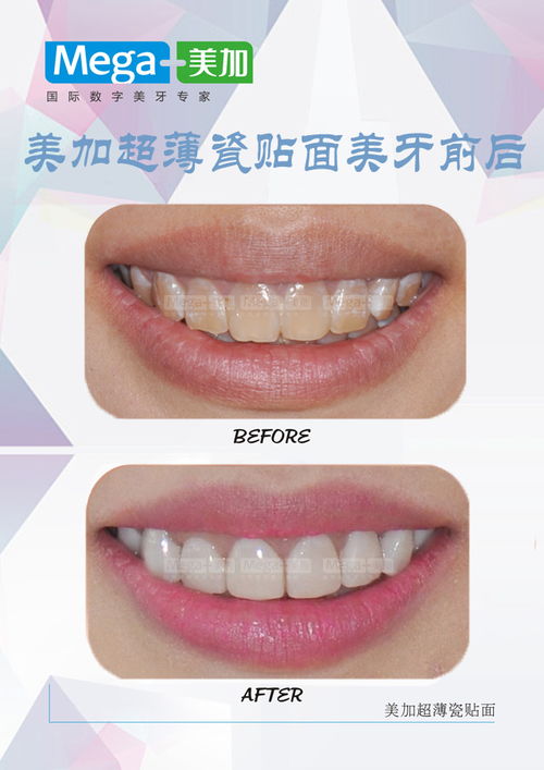 牙齒美白的速效 面膜