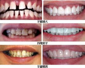 納米釉質牙齒美白再成型