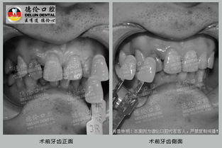 齲齒 牙齒缺失牙齒美容修復修復 牙齒也是男人的門面