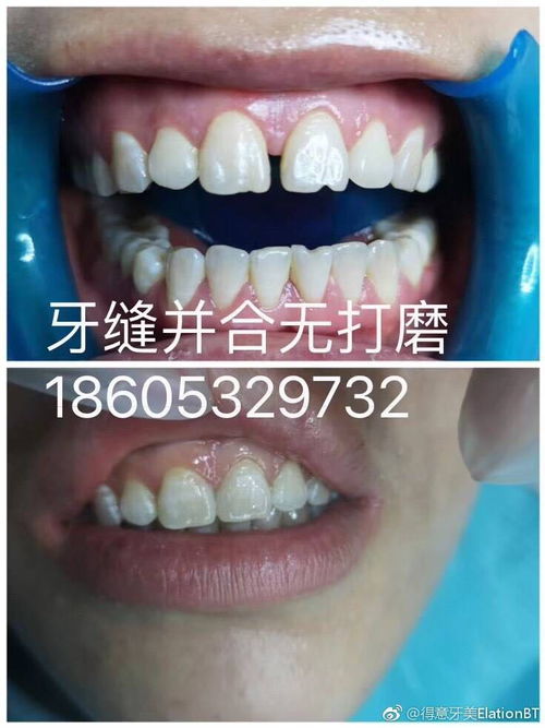德國ur仿生美白牙齒,0打磨0傷害修補斷牙,殘缺牙...