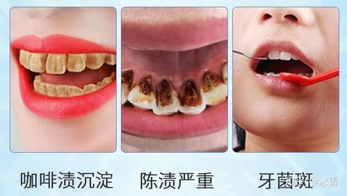 哪種牙膏比較美白