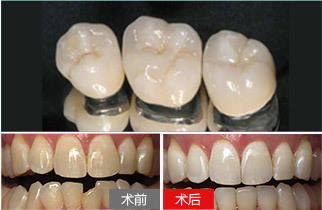 上海做烤瓷牙需要多少錢