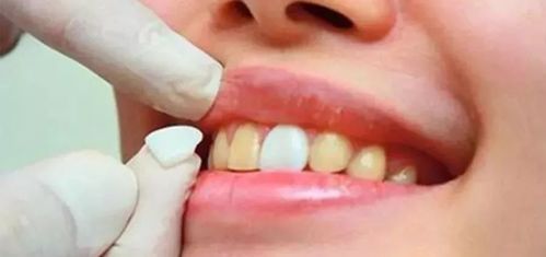火遍朋友圈的牙齒冷光美白并非人人適用