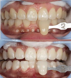 牙齒真的越白越好嗎