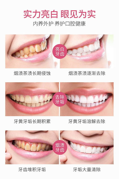 koogis 珍珠炫白潔牙慕斯.櫻花味60ml 潔白牙齒泡沫牙膏去黃牙煙牙口臭口氣