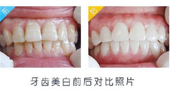 深圳牙齒美白有什么好方法