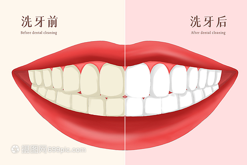 牙齒美容之洗牙前后對比插畫