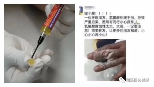 在美容院做完 美牙貼面 ,我后悔了