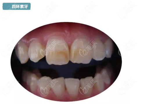 黃牙做冷光牙齒美白多少錢一次 為啥牙醫說千萬不要做冷光美白