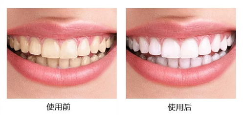 不用花幾千塊去醫院做冷光,在家就能美白牙齒