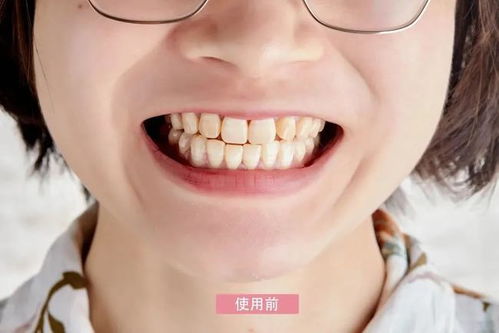 美牙儀,真的可以美白牙齒嗎