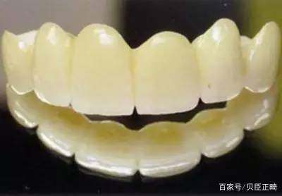 牙齒美容冠適合哪些人群,有哪些注意事項?