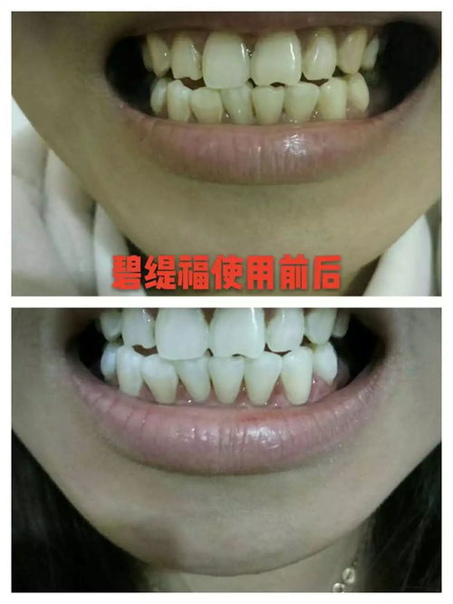 告別大黃牙 這款 國際歐盟認證 的黑科技還你一口大白牙