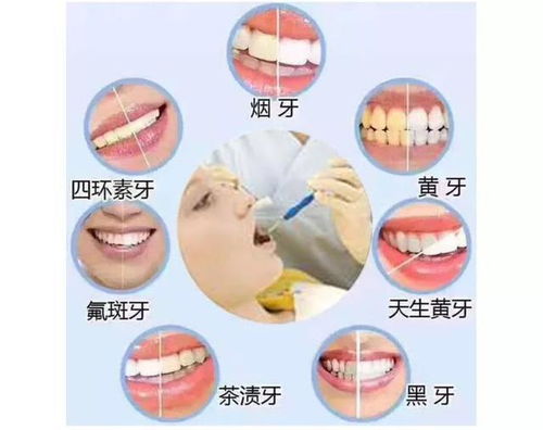 我為什么不用美白牙貼 這些牙齒美白方法能一勞永逸