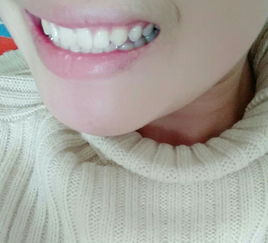 牙齒冷光美白效果怎么樣