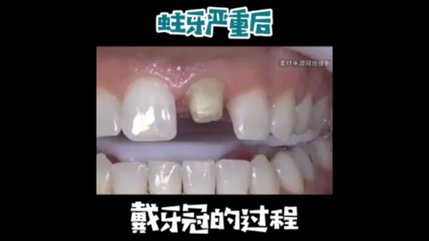全全瓷牙齒貼面全流程。