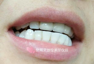 不知道大家有沒有用過牙齒美白儀能美白牙齒嗎 有效果嗎