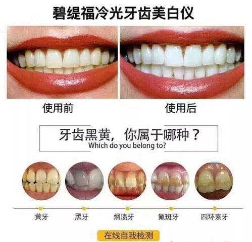 碧緹福冷光牙齒美白儀常問問題解答