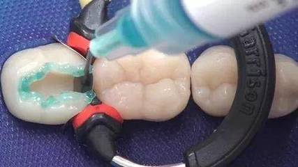 同樣是補牙,為什么我去補牙,價格卻這么貴?