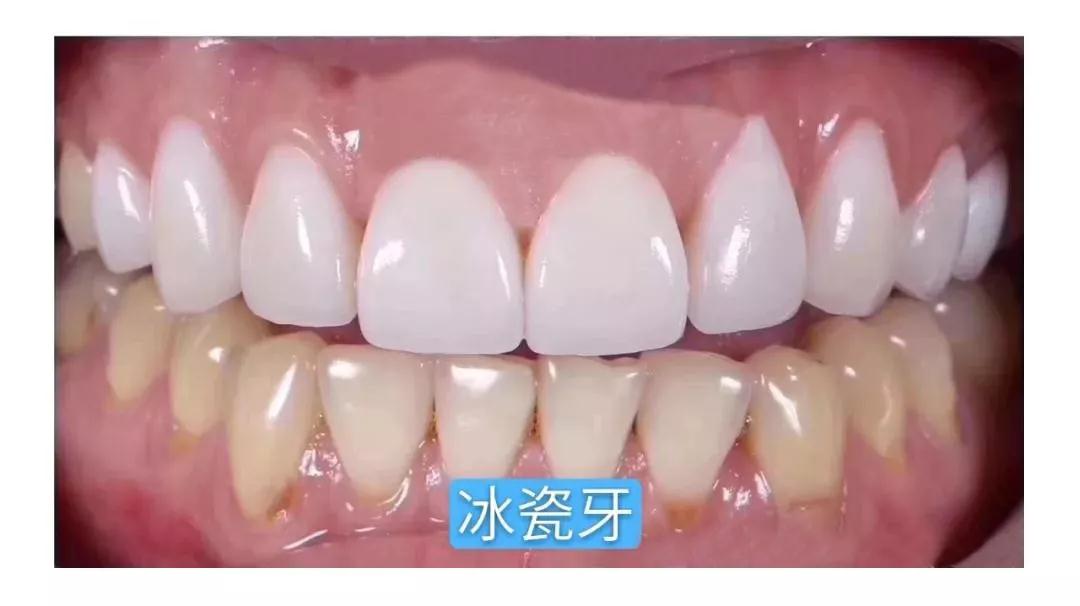 明星都是一口閃亮的大白牙,深受歡迎的"牙貼面"到底是什么神器