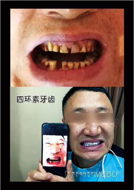 小月的牙齒美白創業記