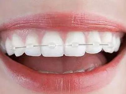 美呀麗牙隱形矯正