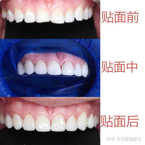 深圳美白牙貼面 牙齒貼面修復(fù)案例分享
