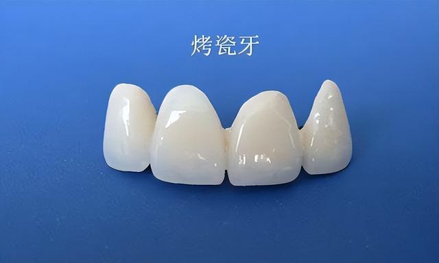 美白牙齒能恢復(fù)原本的白色,但需要時(shí)間,在美白前要做好準(zhǔn)備工作
