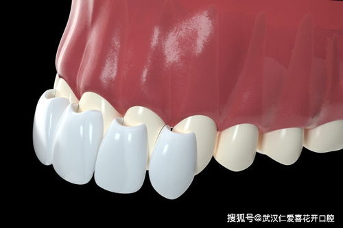美白牙貼or牙齒貼面 別再傻傻分不清楚了
