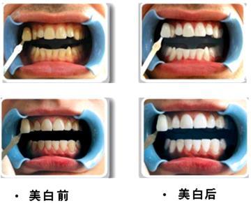 醫(yī)生有你 牙齒美白會(huì)有什么危害嗎