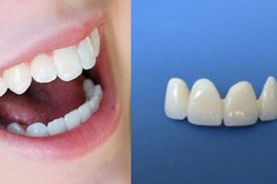 烤瓷牙使用需注意 正規(guī)安裝讓你的牙齒重獲新生